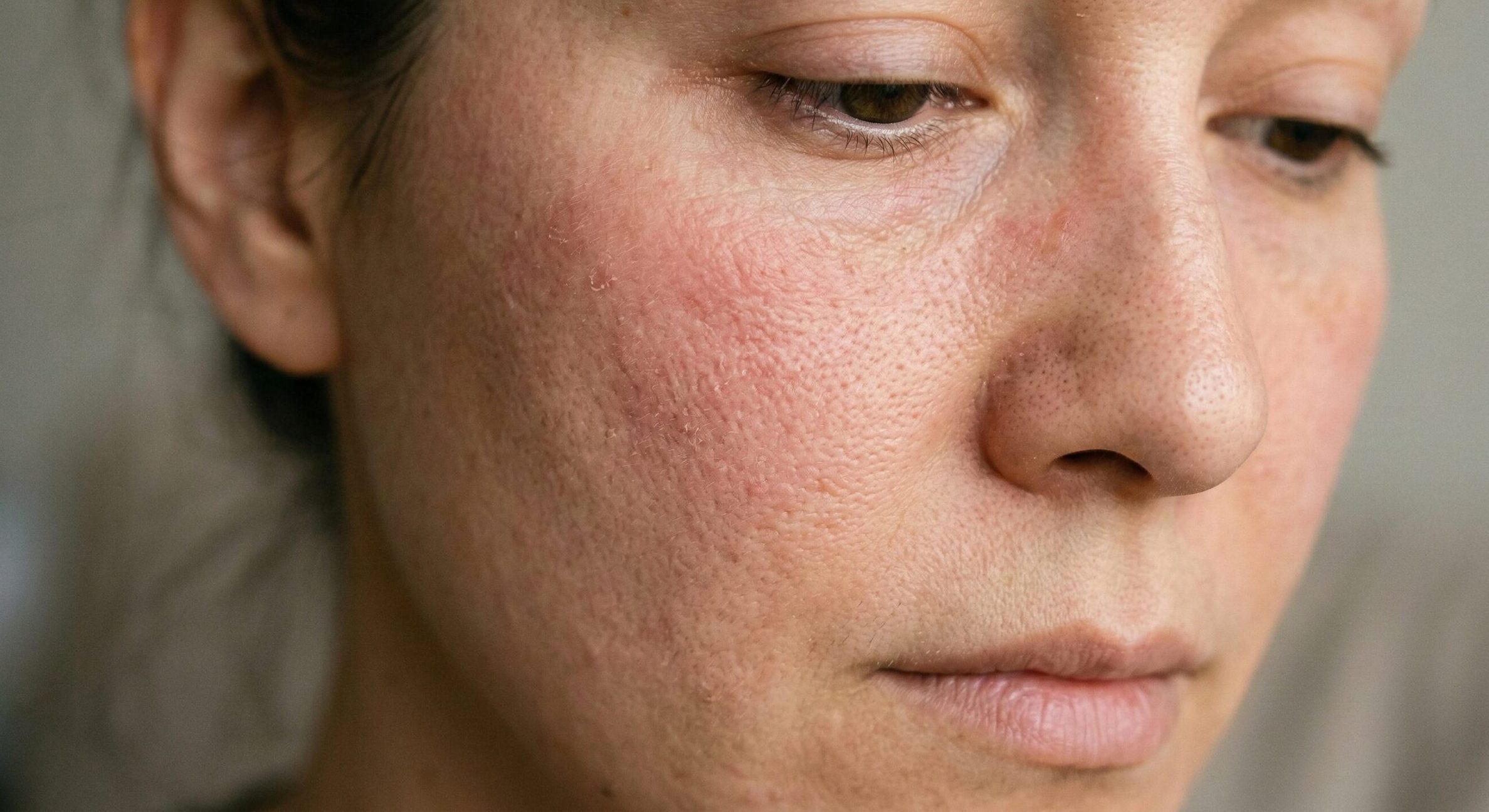 Signs of a Damaged Skin Barrier